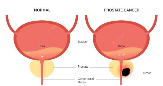 Understanding Prostate Cancer Causes Symptoms And Treatment Options